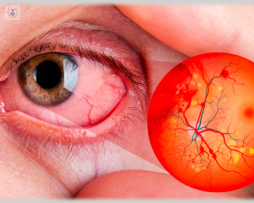 Un diagnóstico precoz, clave en la Retinopatía Diabética