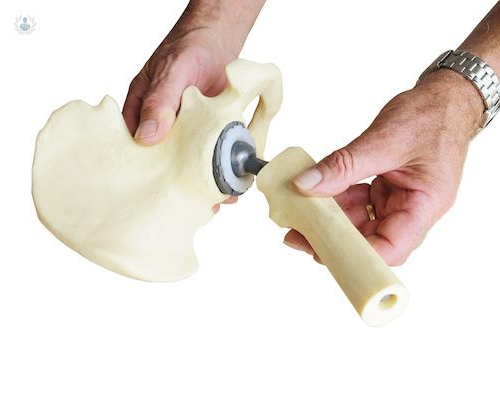 recambio-de-protesis-de-cadera-el-dolor-es-la-senal-de-alarma imagen de artículo