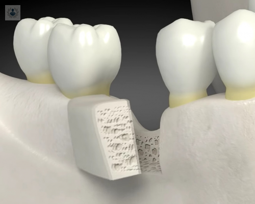 implantes-colocados-sobre-injertos-oseos imagen de artículo