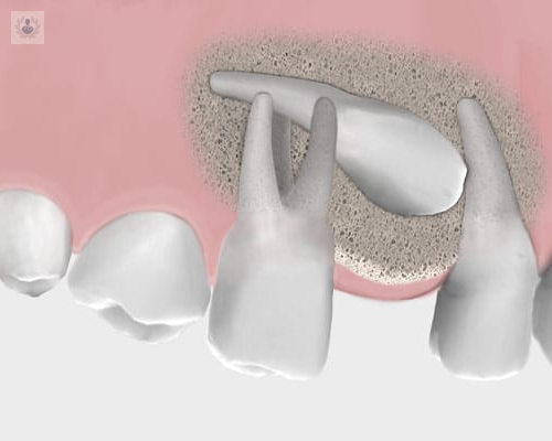 dudas-sobre-las-inclusiones-dentarias imagen de artículo