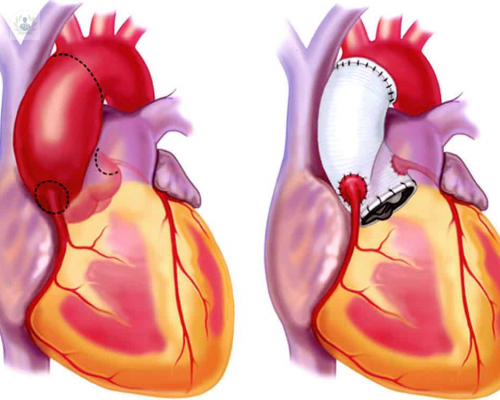 “La Raíz Aórtica es la porción más proximal a la principal arteria del cuerpo, la aorta”