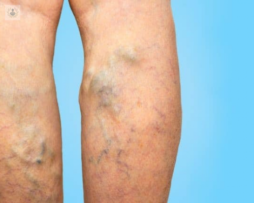 cirugia-ambulatoria-de-varices imagen de artículo