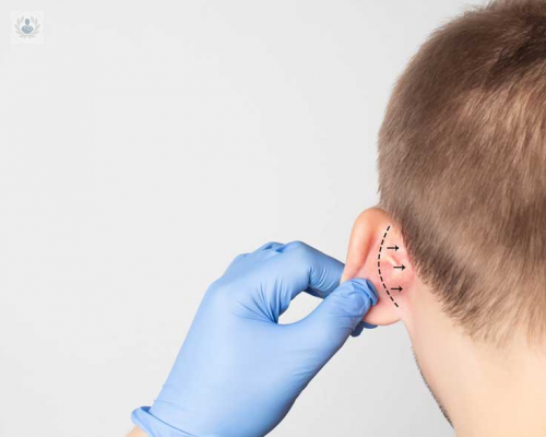 la-otoplastia-procedimiento-y-ventajas imagen de artículo