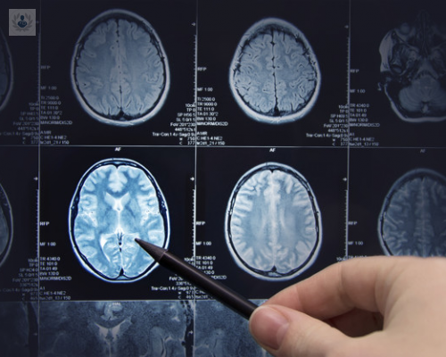 todo-lo-que-debe-saber-sobre-el-aneurisma-cerebral imagen de artículo