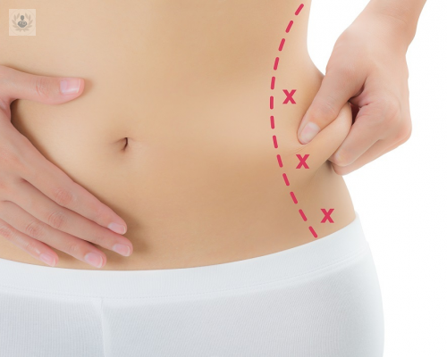 laserlipolisis-para-eliminar-la-grasa-localizada imagen de artículo