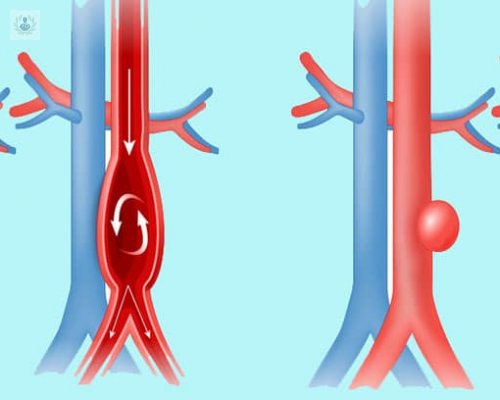 aneurisma-de-aorta-como-detectarlos-y-tratarlos imagen de artículo