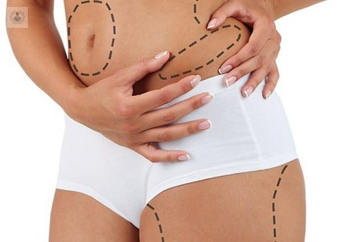 la-liposuccion-no-es-un-metodo-de-adelgazamiento imagen de artículo