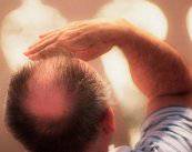 la-alopecia-tiene-solucion imagen de artículo