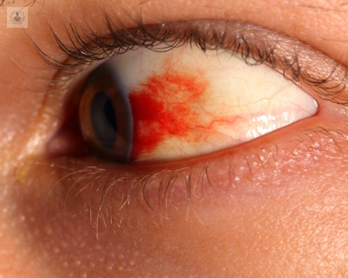 edema-macular-una-enfermedad-indolora imagen de artículo