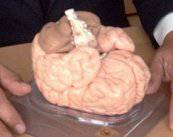 tumores-del-sistema-nervioso imagen de artículo