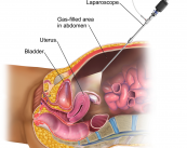 laparoscopia-e-histeroscopia-tecnicas-endoscopicas-de-la-ginecologia imagen de artículo