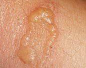 novedades-en-el-tratamiento-de-las-queratosis-actinicas-o-precancer imagen de artículo