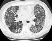 el-abordaje-del-cancer-de-pulmon imagen de artículo