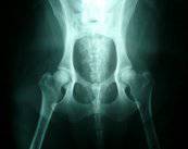 caderas-en-manos-expertas imagen de artículo