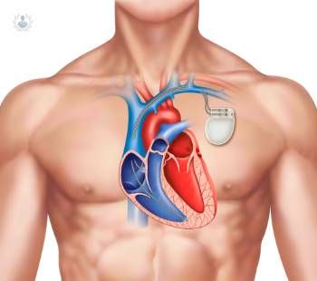 marcapasos-el-dispositivo-que-le-da-ritmo-al-corazon imagen de artículo