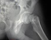 fracturas-de-cadera-sintomas-causas-y-tratamientos imagen de artículo