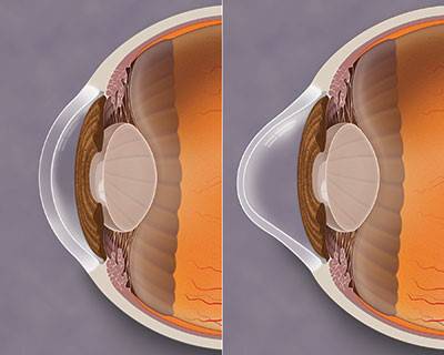 queratocono-una-enfermedad-degenerativa-de-la-cornea imagen de artículo