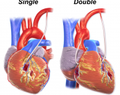 en-que-consiste-la-tecnica-del-bypass-aortocoronario imagen de artículo