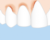 Gingivitis y Periodontitis: la importancia de prevenir enfermedades de las encías