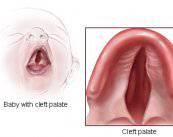las-claves-de-la-fisura-palatina imagen de artículo