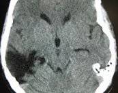 dano-cerebral-adquirido imagen de artículo