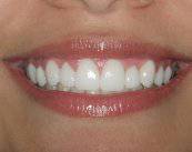 5 preguntas sobre las Carillas Dentales Mínimamente Invasivas