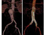 The aneurysm of aorta: diagnosis and treatment