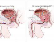 tratamiento-del-cancer-de-prostata-siempre-es-necesario imagen de artículo