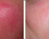 antes-y-despues-de-un-tratamiento-laser-de-rosacea imagen de artículo