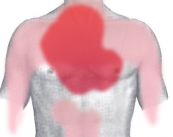 isquemia-aguda-sintomas-y-tratamiento imagen de artículo