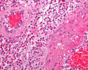 las-claves-de-la-vasculitis imagen de artículo