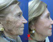 Rejuvenecimiento Facial sin cirugía: twenty skin face y lifting líquido