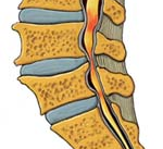 Estenosis de Canal Lumbar: caso de un paciente