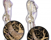 osteoporosis-su-relacion-con-el-cancer-diagnostico-y-tratamiento imagen de artículo