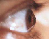 Queratocono, la patología de los ojos en forma cónica e irregular
