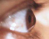 queratocono-la-patologia-de-los-ojos-en-forma-conica-e-irregular imagen de artículo
