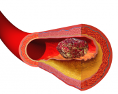 la-trombosis-y-la-embolia imagen de artículo