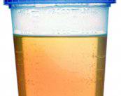 cancer-de-vejiga-deteccion-tratamiento-y-prevencion imagen de artículo