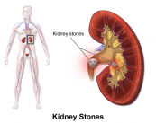 urolitiasis-causas-sintomas-y-tratamiento imagen de artículo