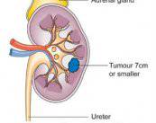 Cáncer Renal: diagnóstico y tratamiento