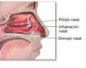 polipos-nasales-causas-sintomas-tratamiento-y-pronostico imagen de artículo