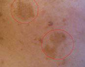 cuida-de-tu-piel-contra-el-melasma imagen de artículo