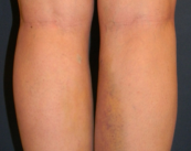 laser-vascular-usos-y-ventajas imagen de artículo