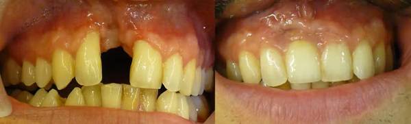 implantes-dentales-la-forma-mas-eficaz-de-recuperar-tu-sonrisa imagen de artículo