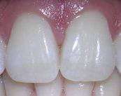 endodoncia-causas-tratamiento-y-posibles-riesgos imagen de artículo