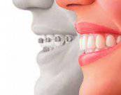 ortodoncia-estetica-tipologias-y-beneficios imagen de artículo
