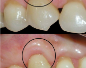 Enfermedades periodontales: la Gingivitis y la Periodontitis
