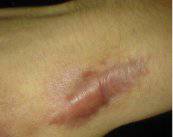 Tratamientos de las cicatrices hipertróficas y los queloides 