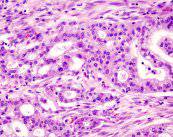 guia-del-cancer-de-pancreas imagen de artículo