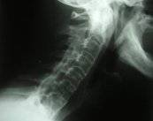 espondilitis-una-enfermedad-frecuente-en-varones-menores-de-30-anos imagen de artículo